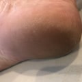 Understanding VA Disability Ratings for Flat Feet: An Expert's Perspective