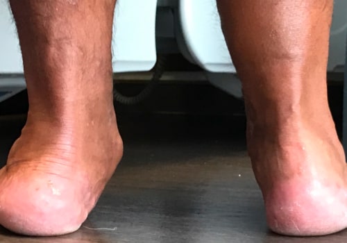Rebuilding Flat Feet: An Expert's Guide